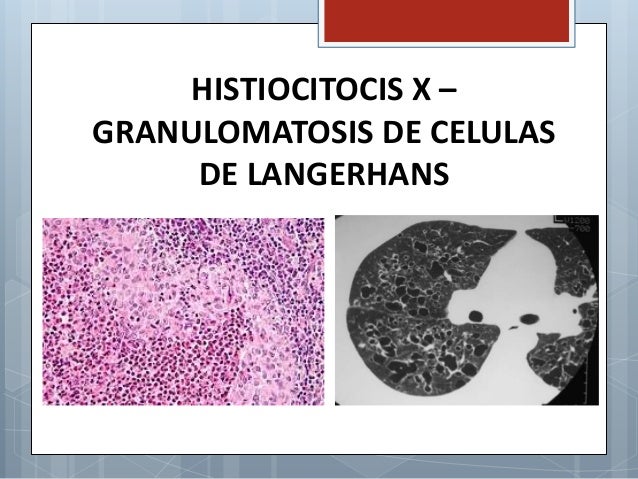 histiocitosis de clulas de langerhans